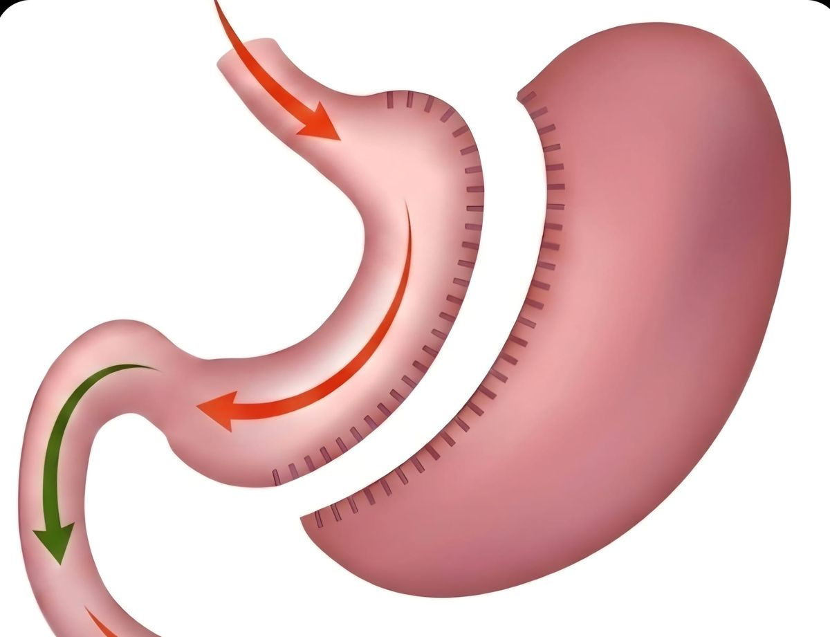 Typically, 70 to 80% of the stomach is removed during a sleeve gastrectomy.