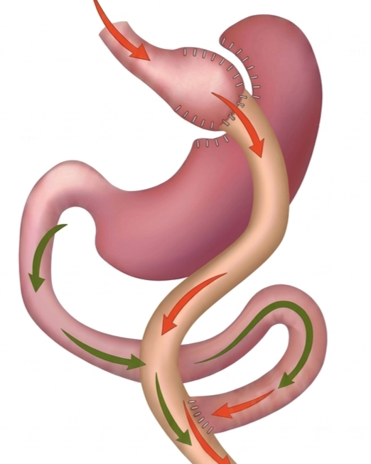 What is Roux-en-Y Gastric Bypass?