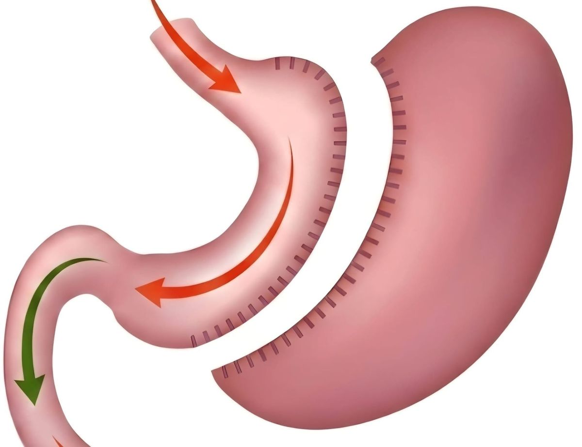 Typically, 70 to 80% of the stomach is removed during a sleeve gastrectomy.