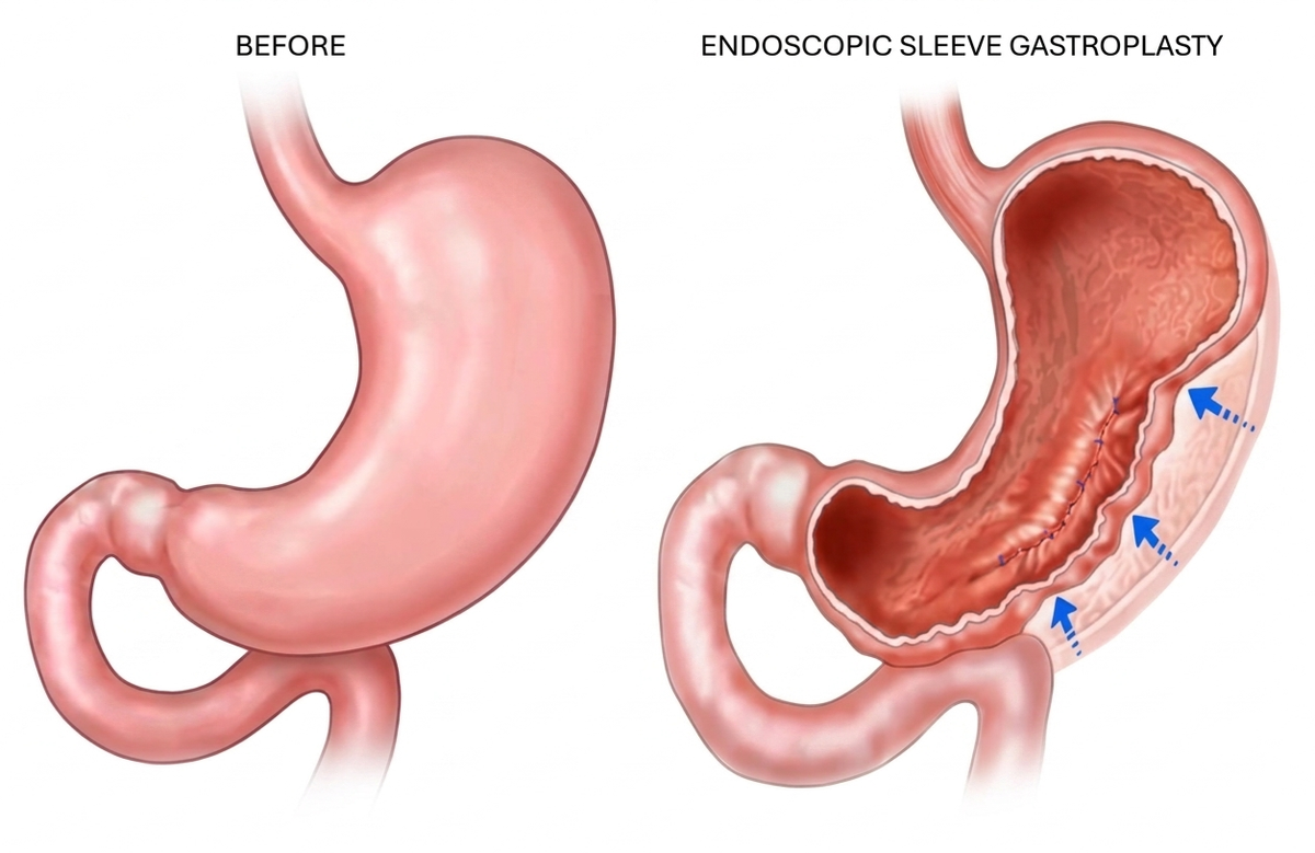 What Is Endoscopic Sleeve Gastroplasty (ESG)?