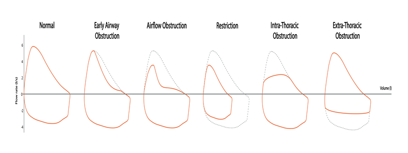 Interpreting Abnormal Lung Function Results: What Do They Mean?