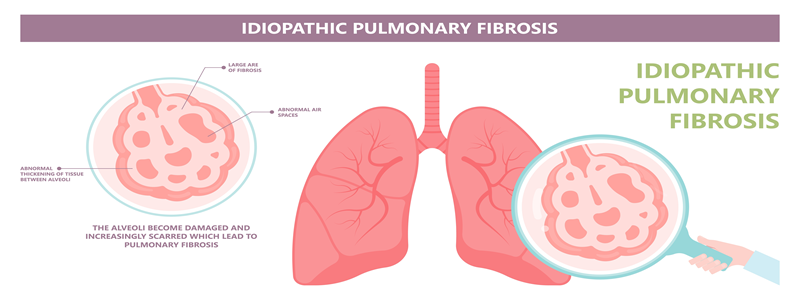 The Role of Pulmonary Rehabilitation in Improving Lung Capacity