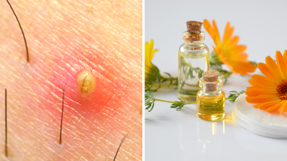 essential oil for ingrown hair