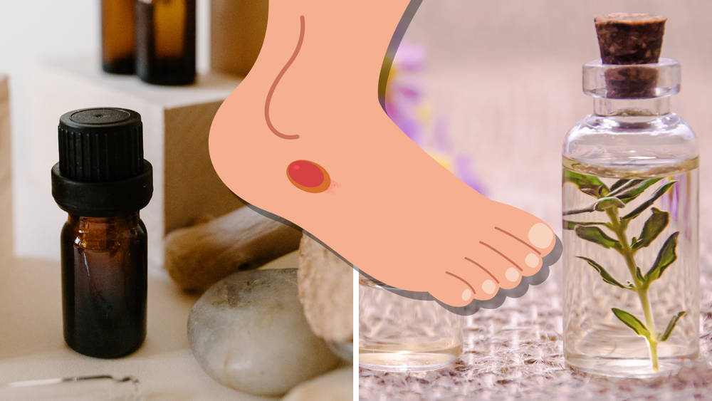 essential oils for blisters, image by canva