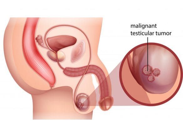 Testicular Cancer: Signs, Symptoms and Treatment options