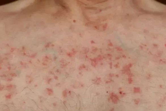 Skin Changes During Chemotherapy – Causes and Management