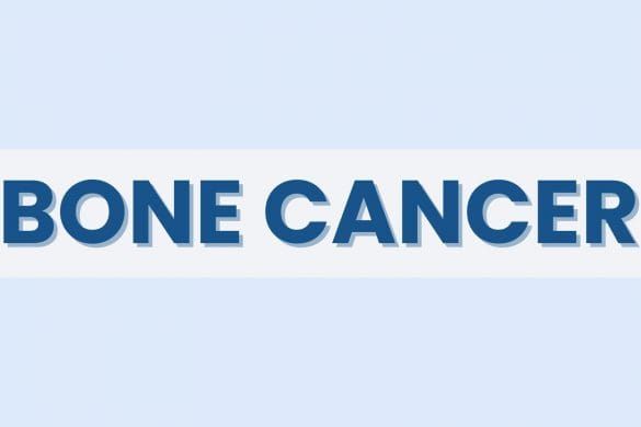 Bone Cancer Fact Sheet: Symptoms, Causes, Treatment