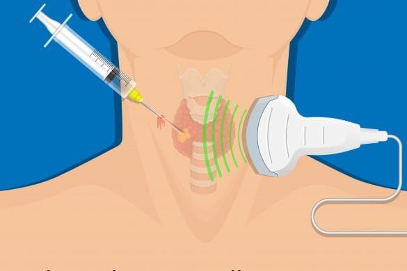 What Can A Lump In Your Thyroid Mean?