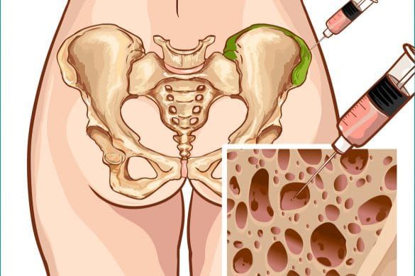 Finding the Best Donors for Bone Marrow Transplantation