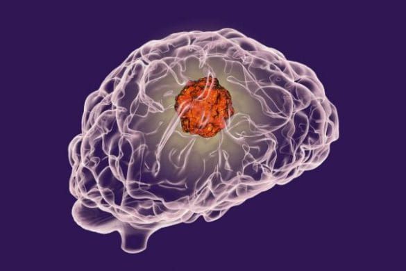 5 Warning Signs of Brain Tumors and Their Treatment