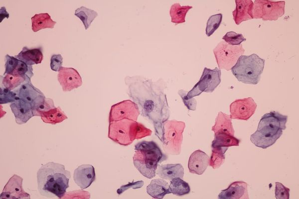 What is cervical squamous cell carcinoma?