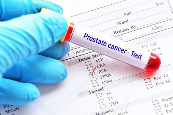 Blood Test Screening for Prostate Cancer