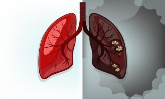 Lung Cancer: What You Should Know
