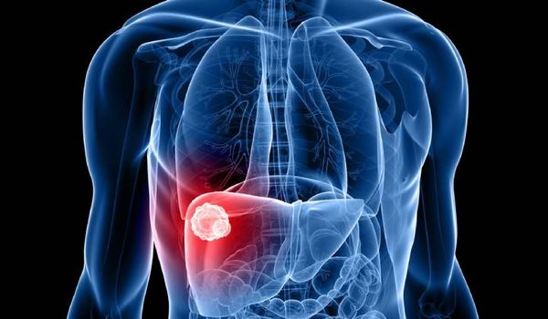 What Are The Treatment Options for Liver Cancer?