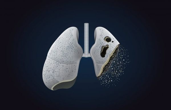 7 Symptoms of Lung Cancer