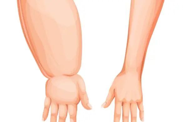 Top 4 Ways to Prevent Lymphedema