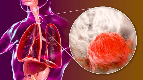 Esophageal Cancer: Symptoms, Diagnosis and Treatment