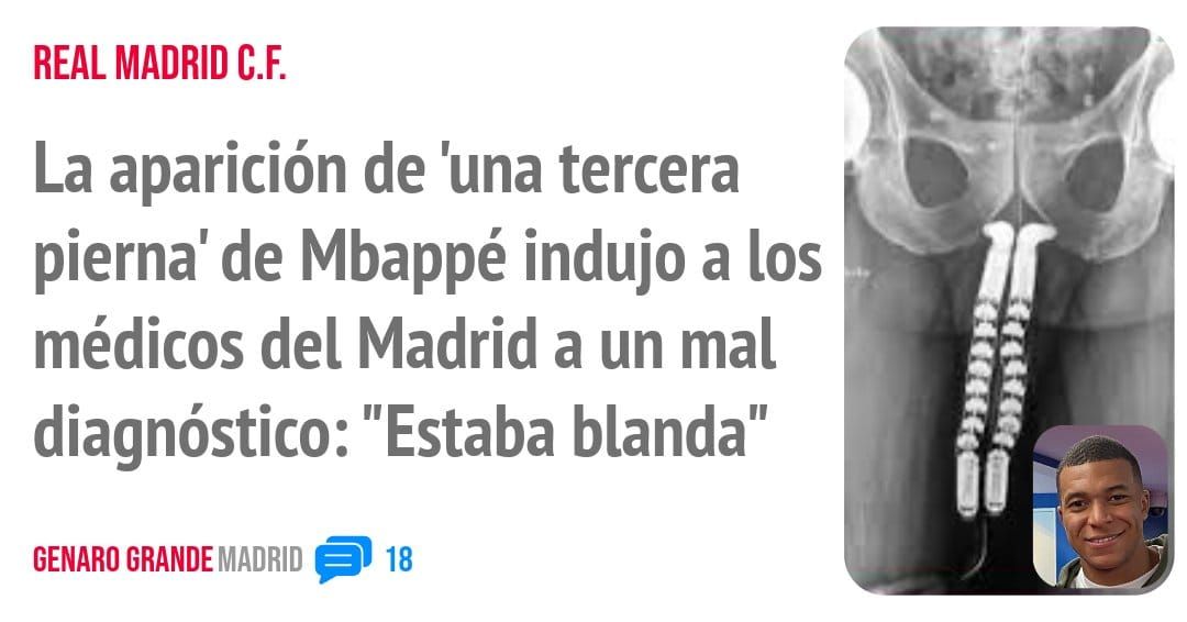REAL MADRID C.F.. La aparición de 'una tercera pierna' de Mbappé indujo a los médicos del Madrid a un mal diagnóstico: "Estaba blanda"