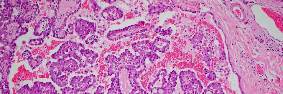 Forpath Seminar - Salivary Gland Tumor Pathology: An Overview