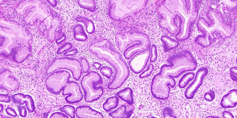 Gastric Polyps: Routine Finding or Diagnostic Pitfall?