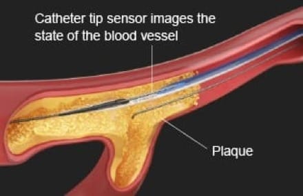 A close up picture of a blood vessel with a catheter which has a sensor which can image the state of blood vessel plaque.