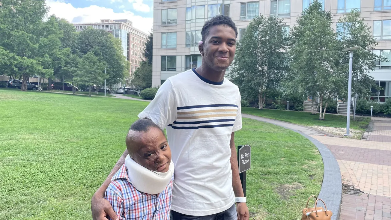 Alvin Núñez Peña de 8 años tiene el 50% de su cuerpo quemado, perdió los dedos, la mano, la oreja, el cabello, se le dañó la