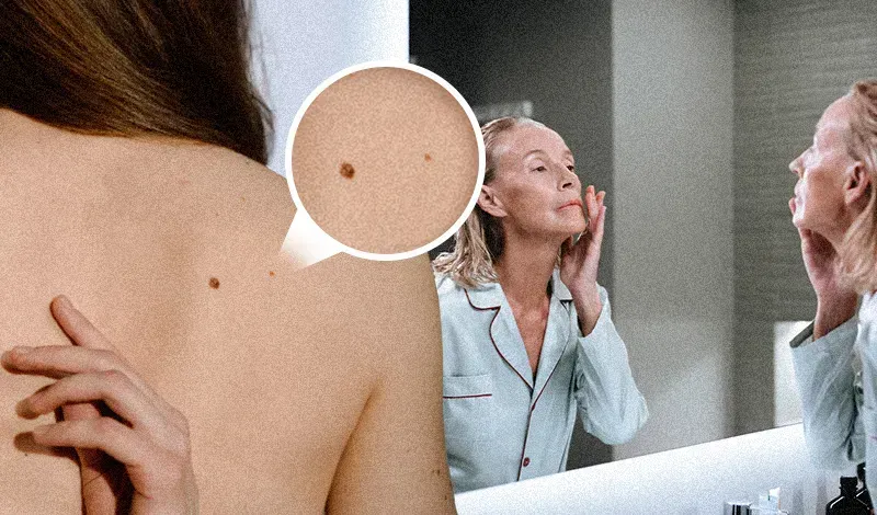 CARCINOMAS. La mayoría de los carcinomas tienen altas probabilidades de curación si se tratan a tiempo, y con métodos efectiv