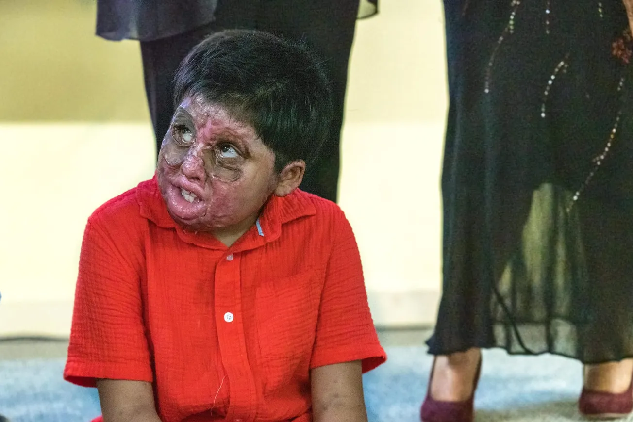 Alexander Salas Quiñónez es de Bolivia tiene 9 años y más del 85% de su cuerpo está quemado, ha sido sometido a 5 procedimien