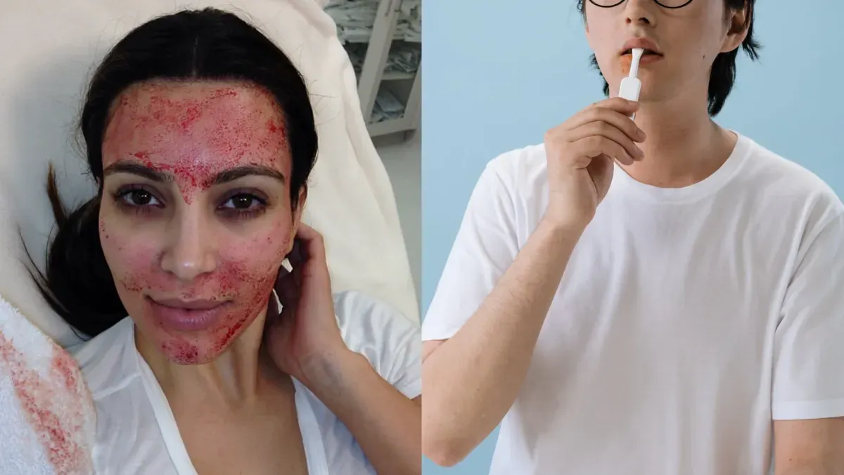 TRATAMIENTO. Durante un tratamiento facial vampiro, se extrae sangre del paciente y luego se inyectan componentes de la sangr