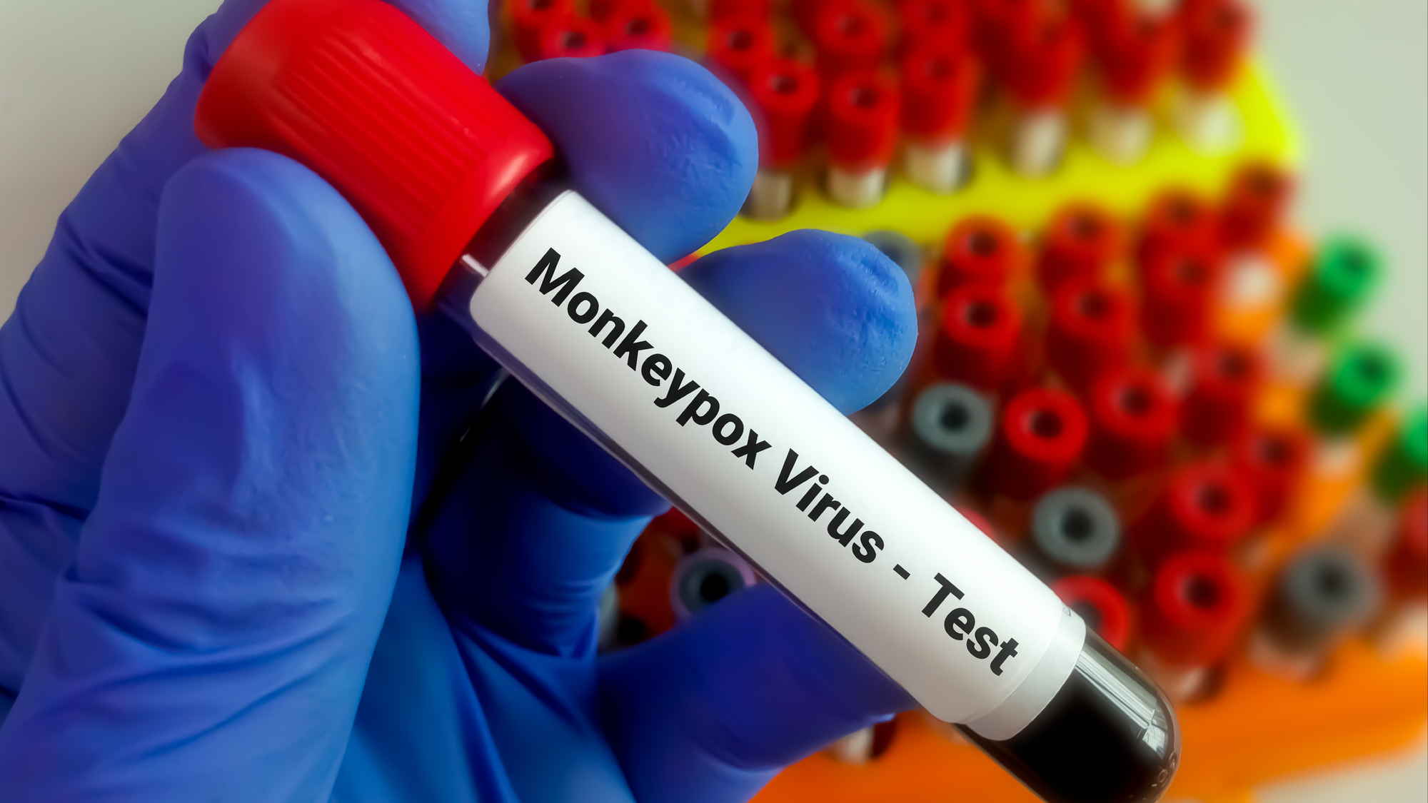 Mpox Cases Rise Sharply As Health Officials Urge Vigilance