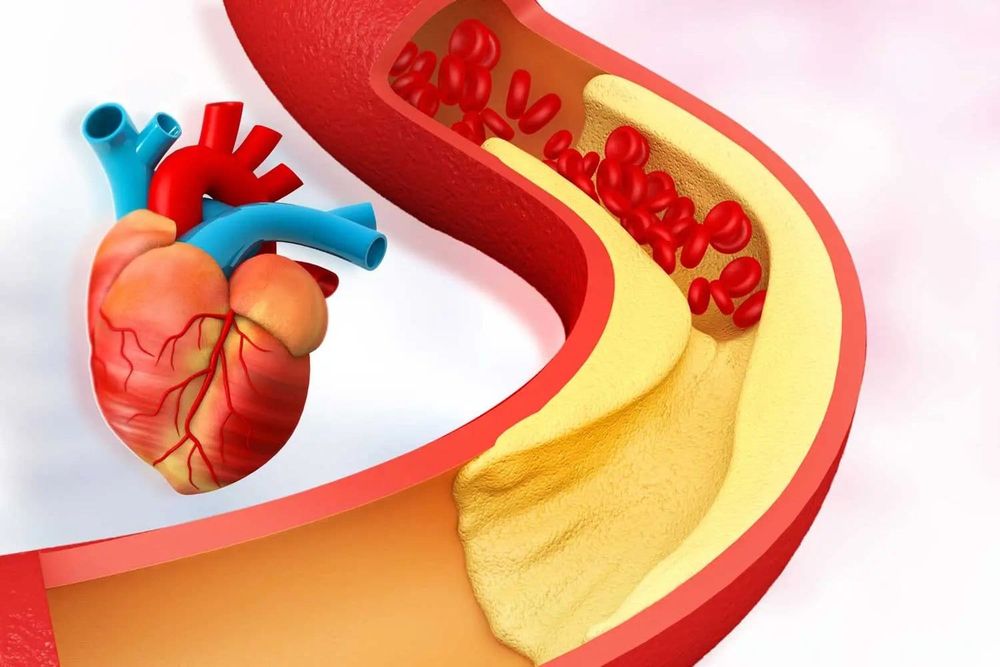 Kolesterol Tinggi: Bahaya Tersembunyi dan Bagaimana GLP-1 Peptida Melindungi Jantung Anda