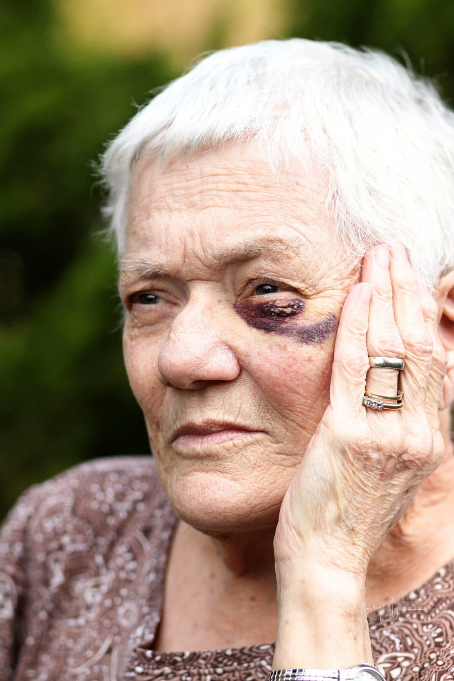 Elderly Woman with Black Eye