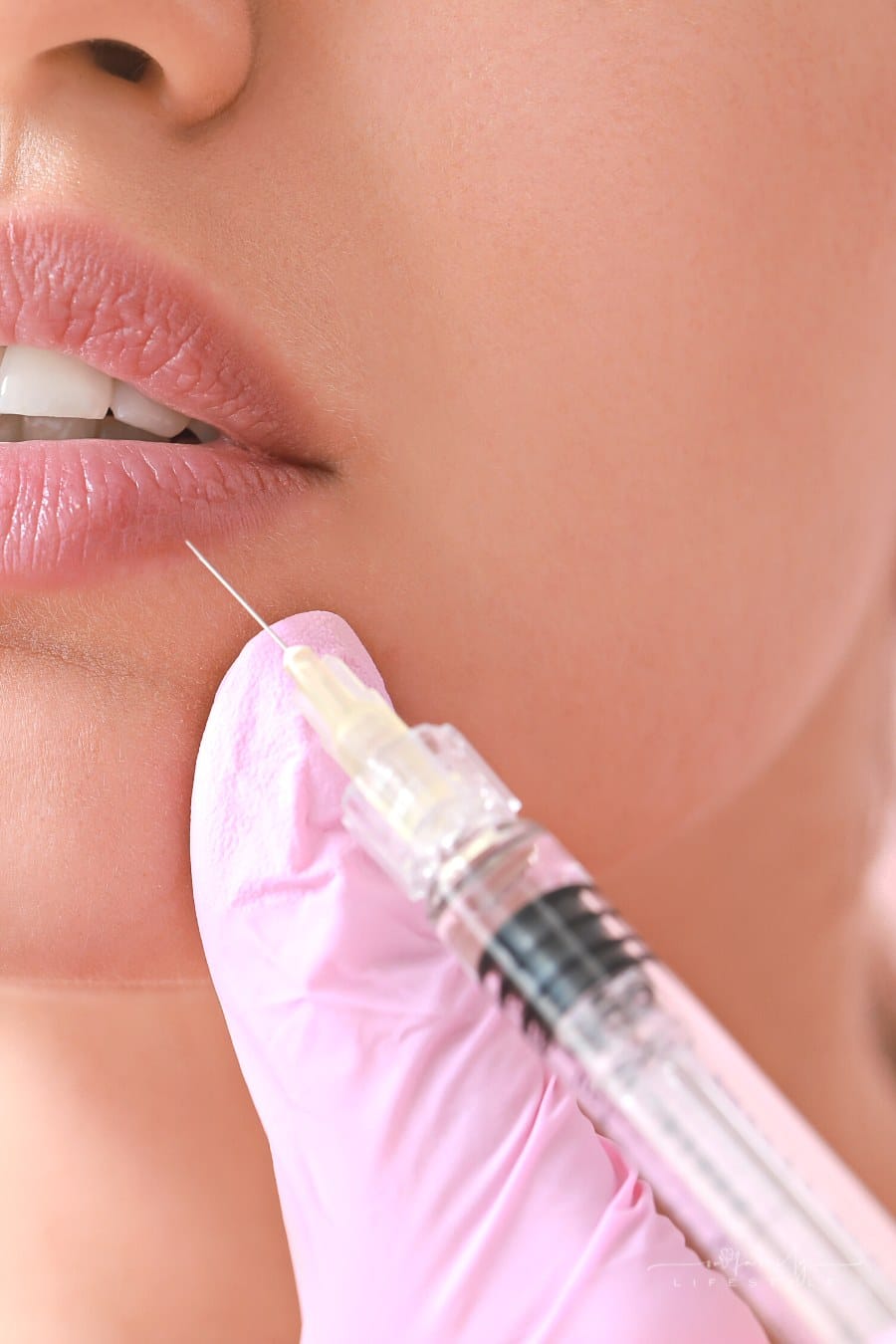 woman receiving lip filler injections