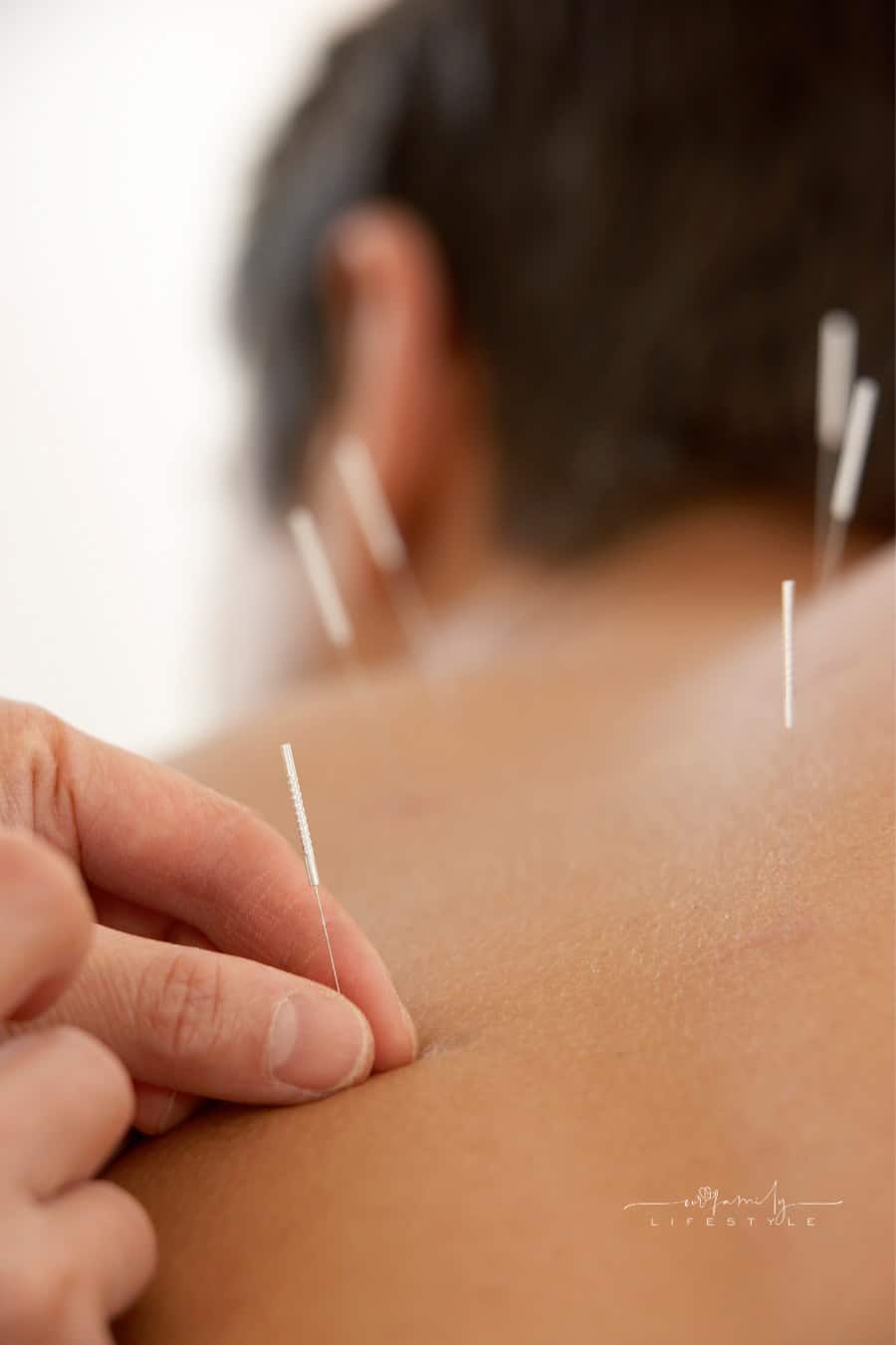Therapist applying acupuncture on man's back