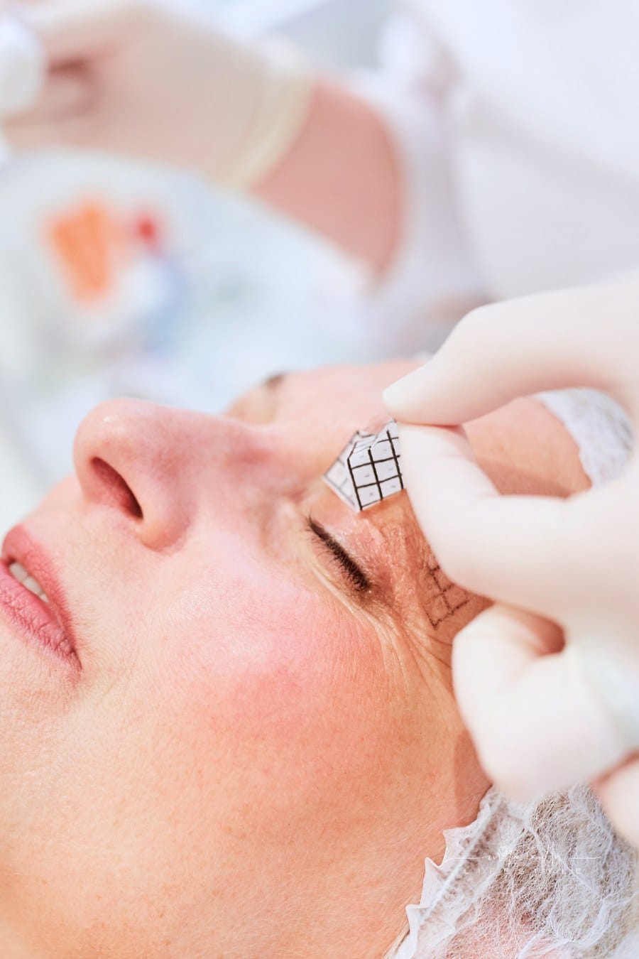 Patient Receives Eyelid Marking for Surgery