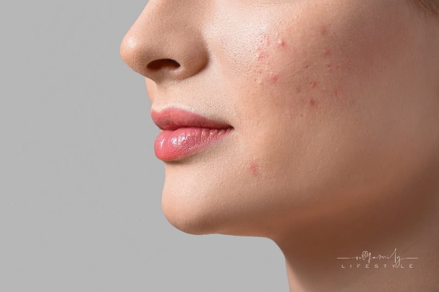 Person with Acne Scarring Problem on Light Background