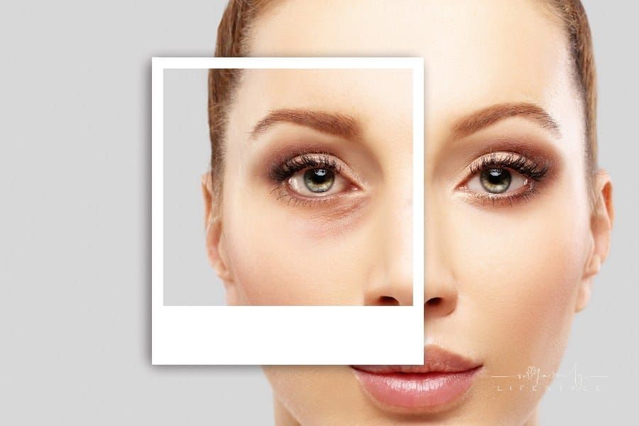 Common Concerns and FAQs About Lower Blepharoplasty Recovery