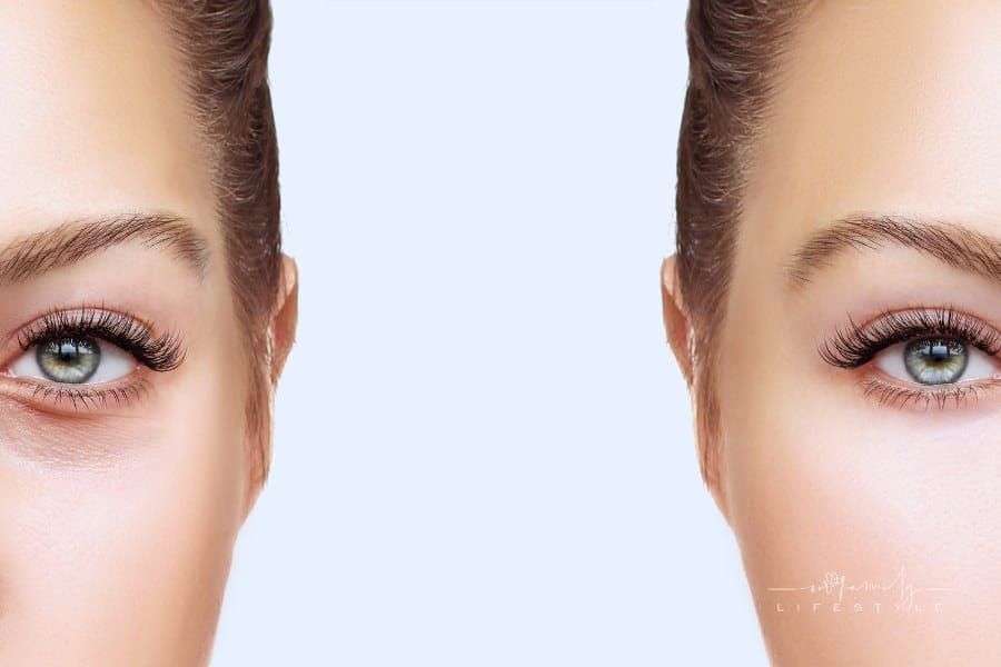 How Eyelid Surgery Enhances Facial Harmony