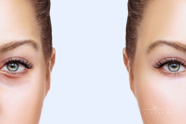 Face Comparison after Lower Blepharoplasty; eyelid surgery