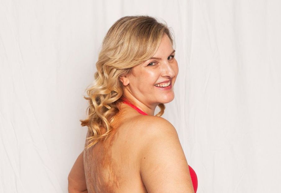 Burns Survivor Hosts Confidence Swimming Sessions for those with Skin Disfigurements