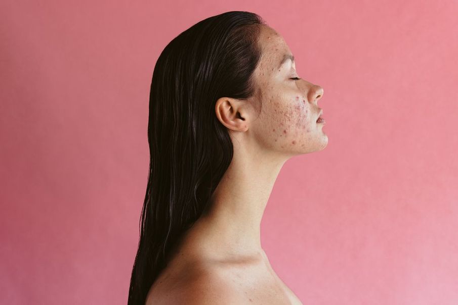 The emotional impact of skin conditions