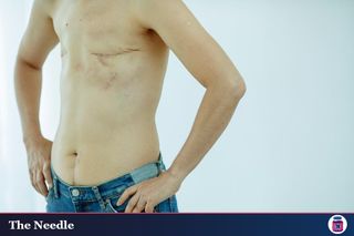 a trans masculine person's torso post mastectomy with his hands on his waist, he is wearing jeans.