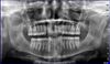 Panoramic dental x-ray of an adult male without third molars