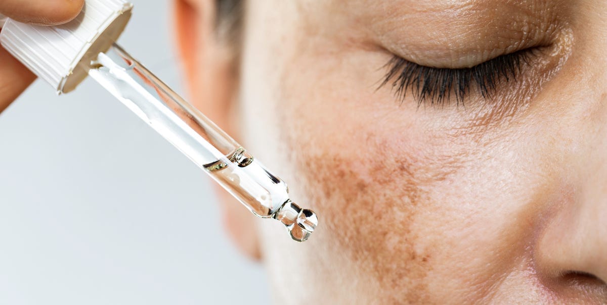 These Are the Best Ways to Treat Melasma, According to Dermatologists