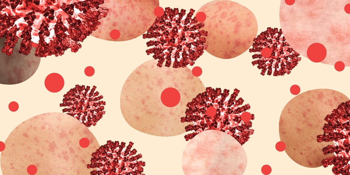 Experts Warn That a Deadly Disease That Causes ‘Immune Amnesia’ Is Surging in the U.S.