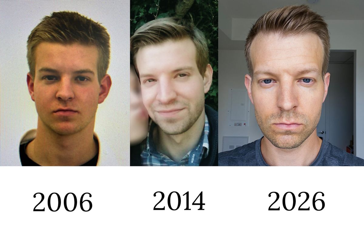How I Reversed My Hair Loss Naturally