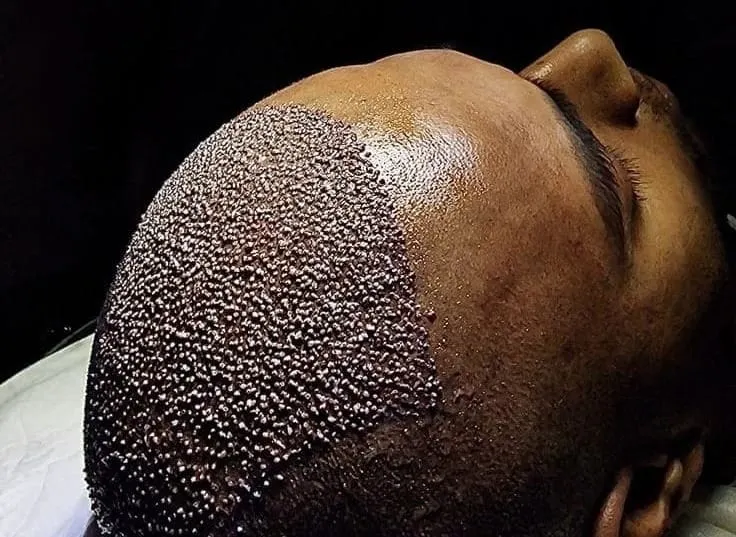 Hair Transplant Cost: What You Need to Know