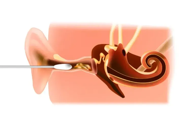 Dealing with Ear Wax Blockage? Discover powerful treatments that can help.