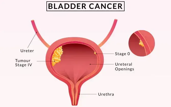 Bladder Cancer Symptoms in Women: Early Warning Signs You Shouldn’t Ignore
