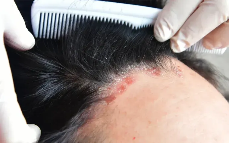 Scalp Psoriasis Explained: Symptoms, Treatments, and Relief Tips for Healthier Skin